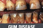 City of New York Attempts to Gross Out Smokers